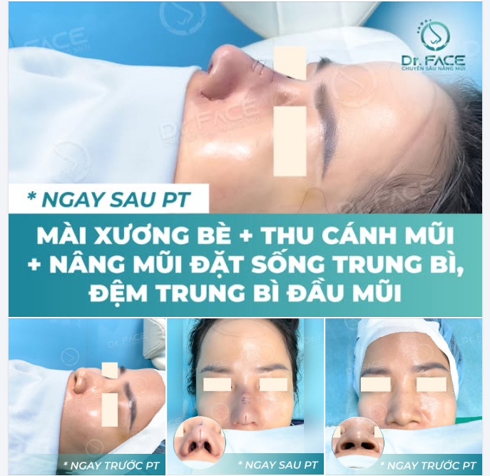 Khi gương mặt BỪNG SÁNG nhờ combo NÂNG MŨI TOÀN DIỆN