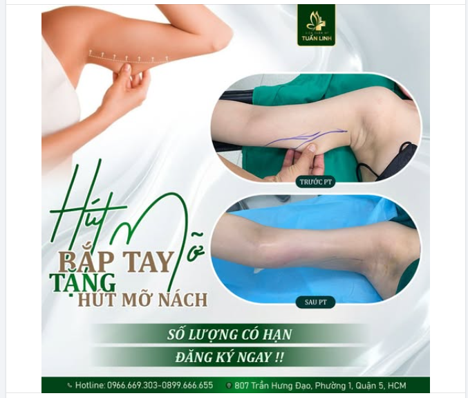 HÚT MỠ BẮP TAY TẶNG NGAY HÚT MỠ NÁCH!!