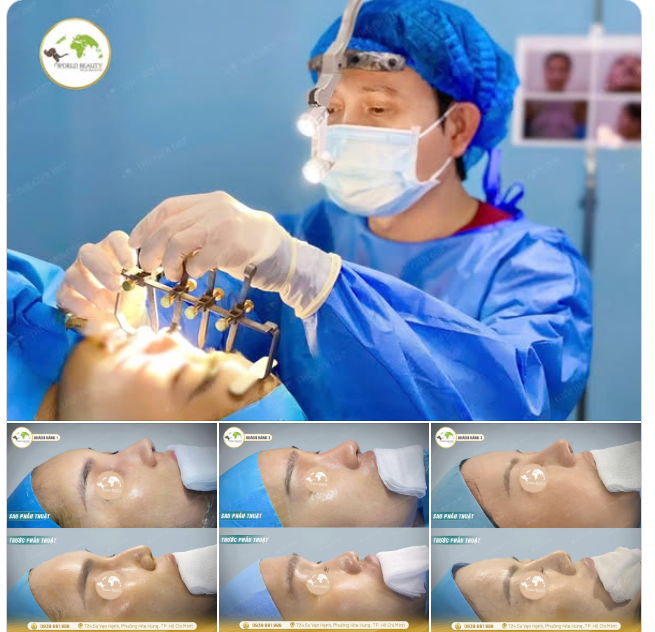 Dù mỗi Khách hàng đến với Thế Giới Đẹp có xuất phát điểm khác nhau, nhưng với nâng mũi – ai cũng mong muốn một kết quả chung: dáng mũi hài hòa, tự nhiên và phù hợp với gương mặt.