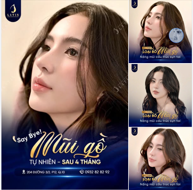 Say bye mũi gồ – Đón dáng mũi mới chuẩn xinh