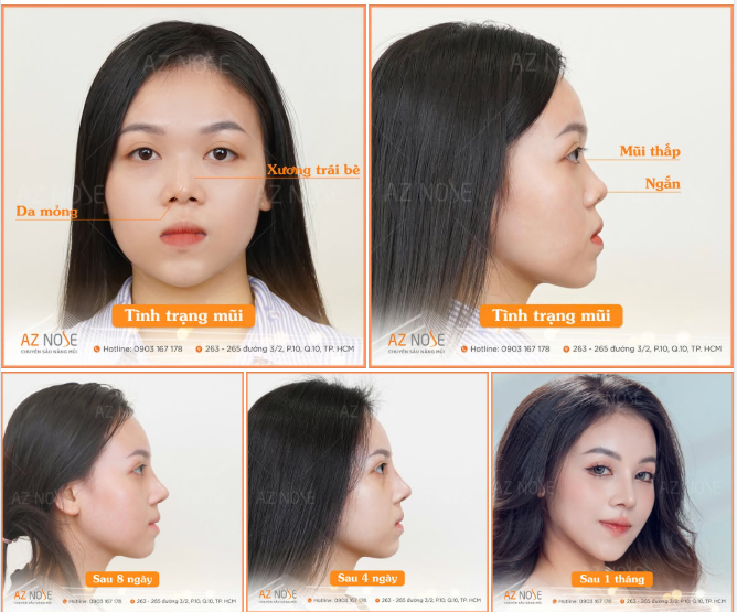 Diện mạo nổi bật của nữ sinh Hutech sau 1 tháng nâng mũi