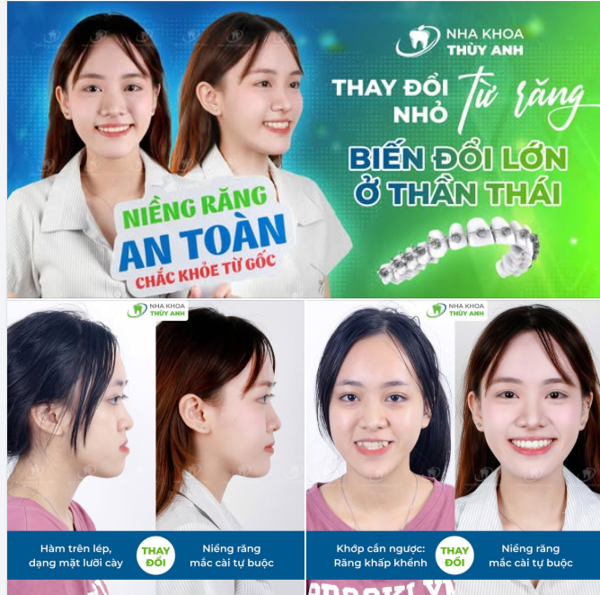 CHỈ NIỀNG RĂNG - VẪN CÓ THỂ ĐẸP ĐẾN NGỠ NGÀNG