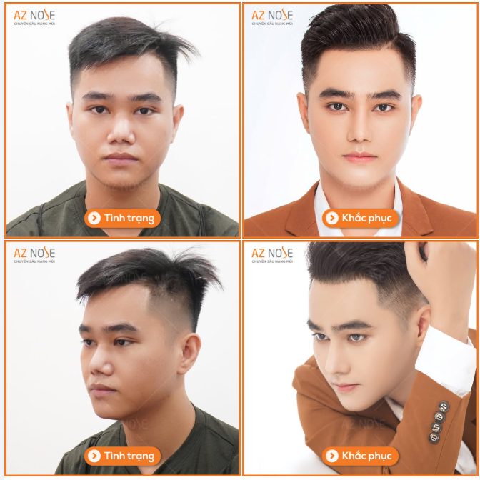 Tạm biệt mũi co rút cùng sẹo ở trụ và cánh mũi, khách hàng đến từ Vĩnh Long lột xác ngoạn mục sau ca năm tái tạo mũi hỏng