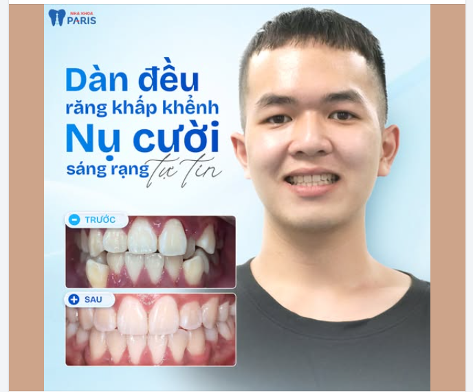 RẠNG TỰ TIN VỚI NỤ CƯỜI MỚI  Điều trị chen chúc khấp khểnh cho KH đến từ TP. HCM  Bác sĩ: Dr. Ngô Quang Tín