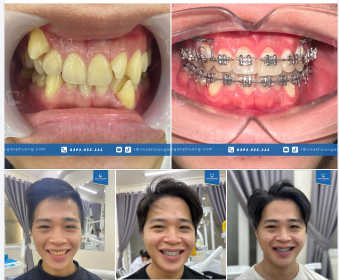 Răng nhảy múa cỡ này, niềng xong rồi đẹp cỡ nào?