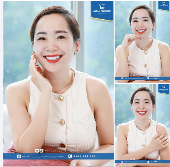 Một ca sứ tái khám sau 2 năm rạng rỡ hơn cả ngày đầu tiên