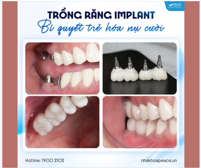 CÓ PHẢI CHỈ CẦN CHỌN TRỤ IMPLANT TỐT LÀ ĐỦ