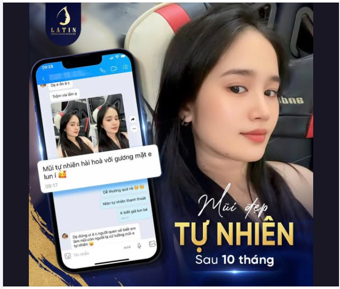 MŨI SURGIFORM SAU 10 THÁNG  VẪN ĐẸP TỰ NHIÊN, HỢP MẶT NHƯ NGÀY ĐẦU