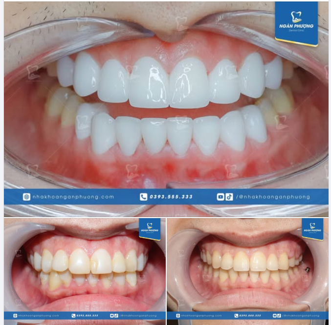 Một hành trình dài từ những chiếc răng khểnh đến nụ cười nam tính, thần thái ngút ngàn.