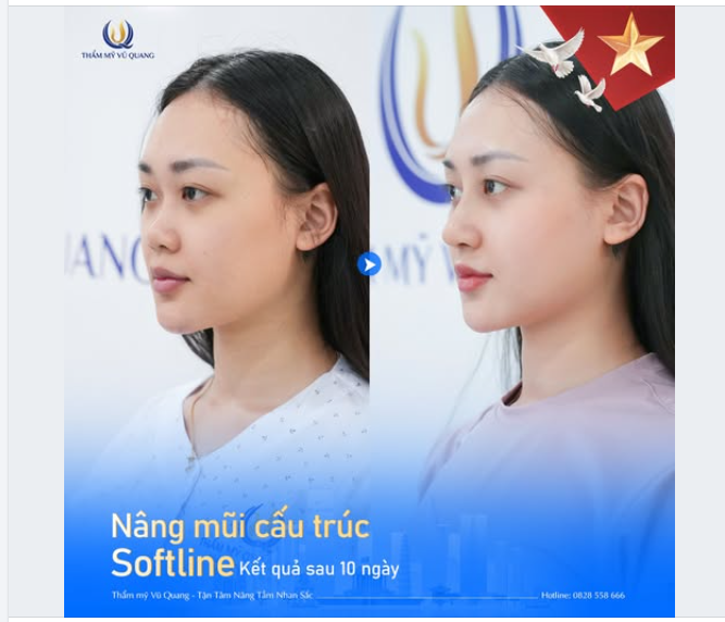 10 NGÀY CẮT CHỈ – SỞ HỮU DÁNG MŨI NHƯ Ý