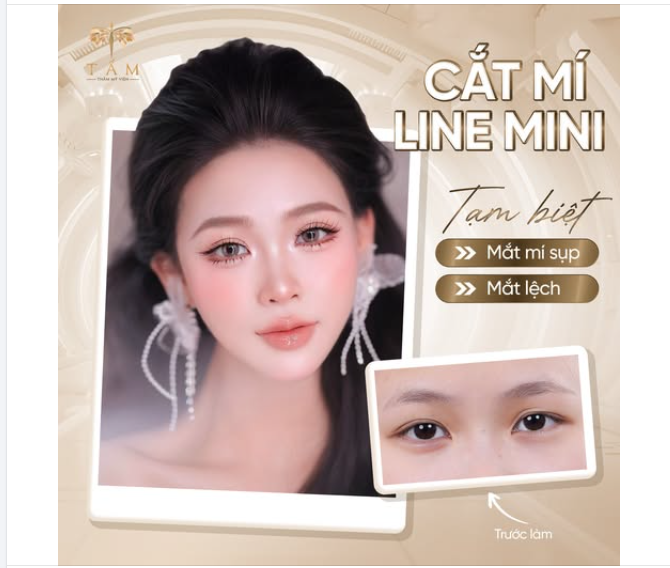 Chỉ với 45 phút, hô biến đôi mắt sụp, lệch thành mắt hai mí tròn, đều, rõ nếp.