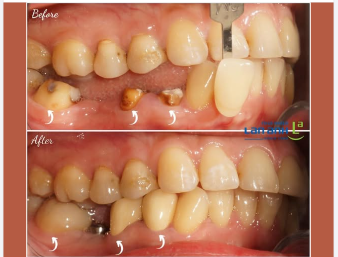 Vì sao cầu răng này làm ở nơi khác lại dễ bị sút và không được chắc chắn, bền vững?