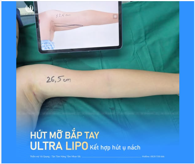 Bắp tay to?  Mỡ lấn át?  Để BS Vũ Quang xử đẹp trong 45 phút!