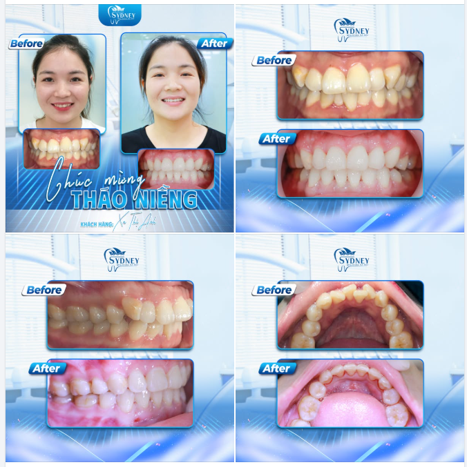 CHÚC MỪNG THÁO NIỀNG KH. XA ANH
