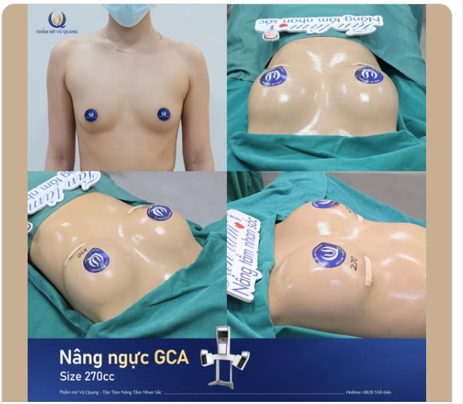 Chưa lập gia đình, chưa sinh con thì nên nâng ngực túi gì?