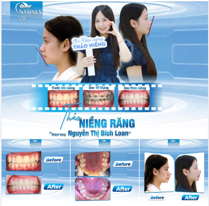 THÁO NIỀNG RĂNG CÙNG KHÁCH HÀNG BÍCH LOAN
