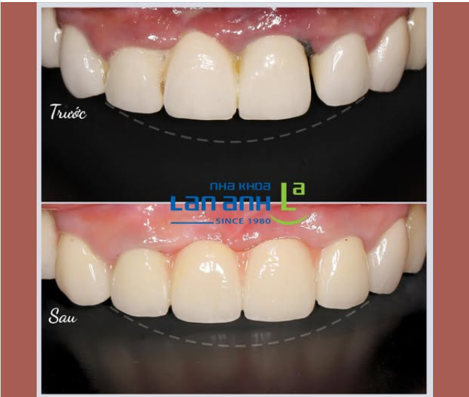 Răng sứ làm ở nơi khác không được tốt: vênh, thiếu chính xác, bị hở, nhét kẽ thức ăn gây viêm nướu, được làm lại tại nha khoa Lan Anh và khắc phục hoàn toàn viêm nướu ạ