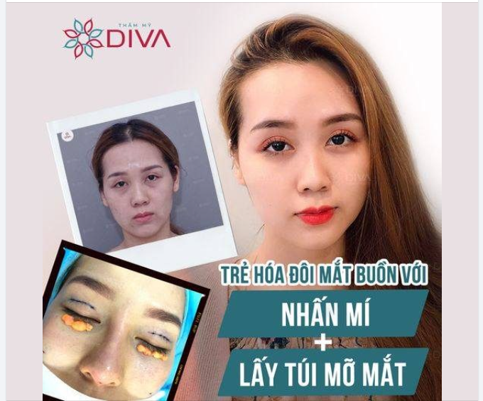 TÚI MỠ LÀM MẮT NẶNG NỀ, TRÔNG BUỒN BÃ - GIẢI PHÁP KHẮC PHỤC LÀ GÌ?