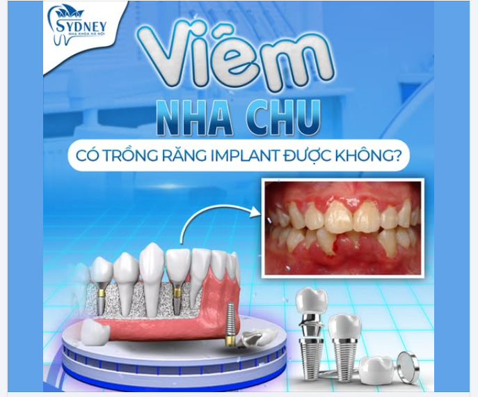 VIÊM NHA CHU CÓ TRỒNG RĂNG IMPLANT ĐƯỢC KHÔNG?