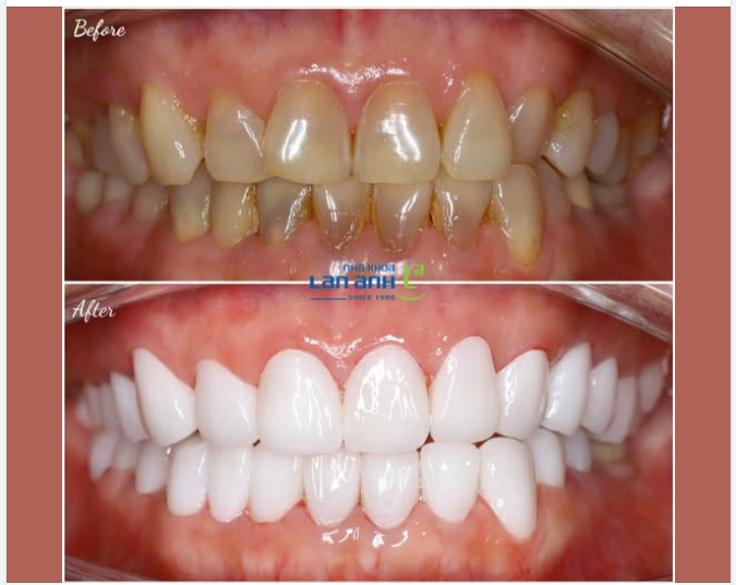 Làm nhiều răng sứ thì dễ hơn, hay khó hơn là làm ít răng sứ
