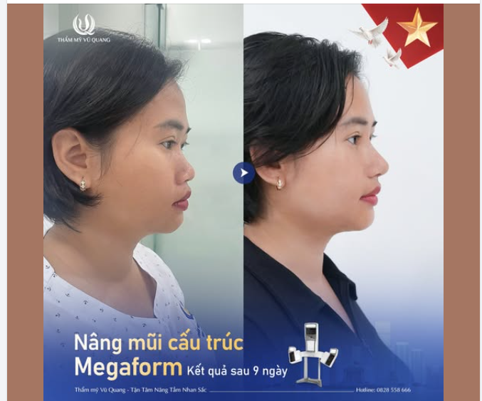 Khi bạn chọn Nâng mũi sụn Megaform tại Thẩm mỹ Vũ Quang – nhan sắc  thần thái cùng lên hương!