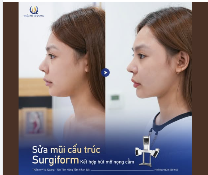 Cô nàng từng tự ti với dáng mũi lệch to thô nhưng đã có màn lột xác ngoạn mục sau khi sửa mũi tại Thẩm mỹ Vũ Quang.