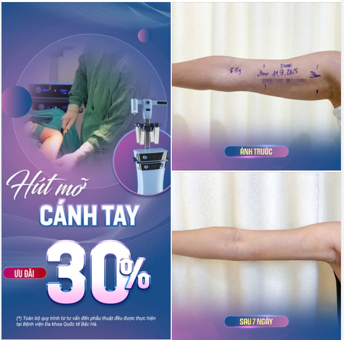 HÚT MỠ CÁNH TAY – THON GỌN TỰ TIN.