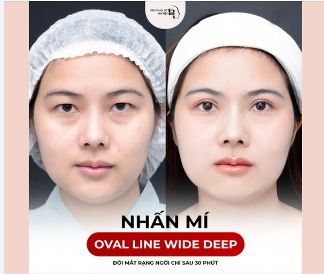 NHẤN MÍ OVAL LINE WIDE DEEP