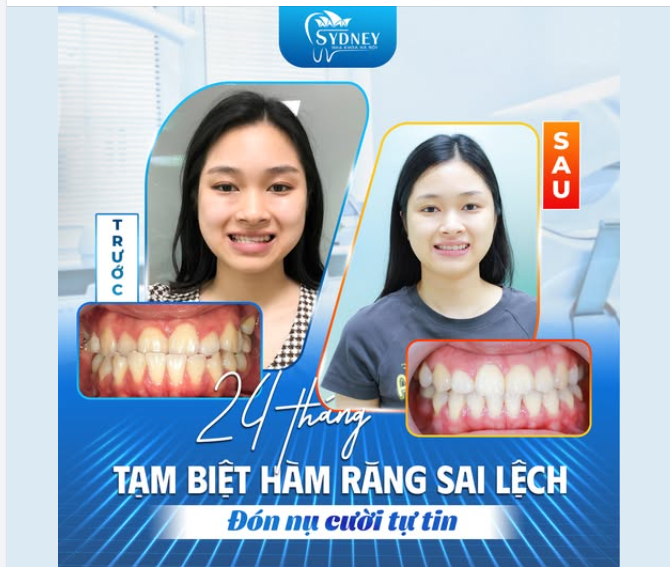 24 THÁNG THAY ĐỔI: TẠM BIỆT RĂNG HÔ, CHÀO ĐÓN NỤ CƯỜI TỰ TIN