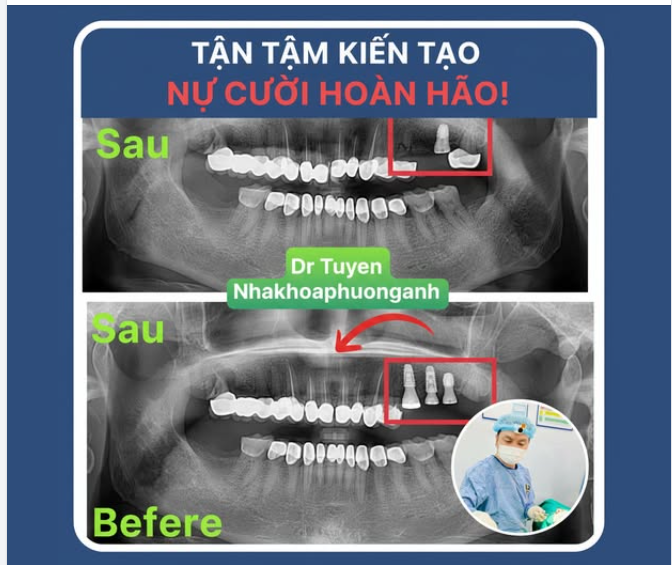 Implant Nha Khoa Có Bền Không?