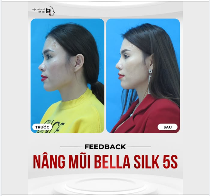 NÂNG MŨI BELLA SILK 5S   Dáng mũi tinh tế - Nâng cấp visual - Không đau 