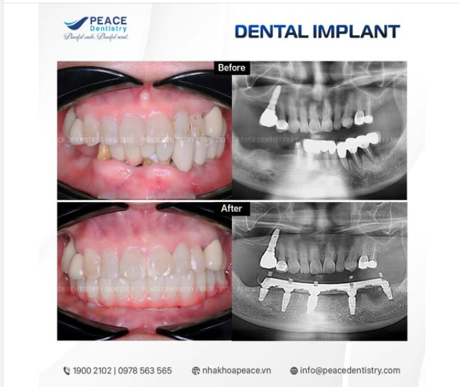 Ca lâm sàng: thay thế cầur ăng sứ dài đã xuống cấp bằng All-on-5 implant giúp mang lại giá tri vượt trội cho khách hàng