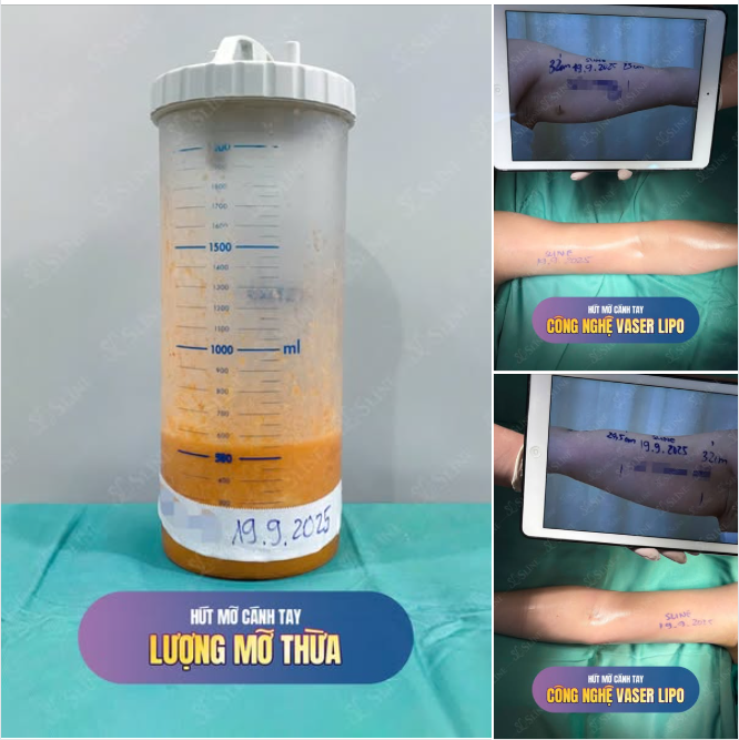 HÚT MỠ CÁNH TAY – KẾT QUẢ VỪA THỰC HIỆN