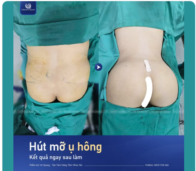 HÚT MỠ Ụ HÔNG - BÍ KÍP SỞ HỮU VÒNG 3 "TRÁI ĐÀO" ĐƠN GIẢN KHÔNG NGỜ