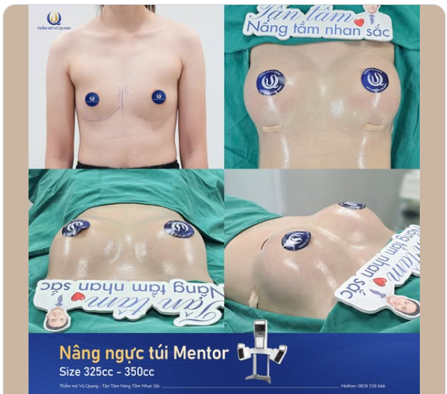 NGẮM KẾT QUẢ SAU 45 PHÚT NÂNG NGỰC ĐẶT TÚI MENTOR size 325cc - 350cc