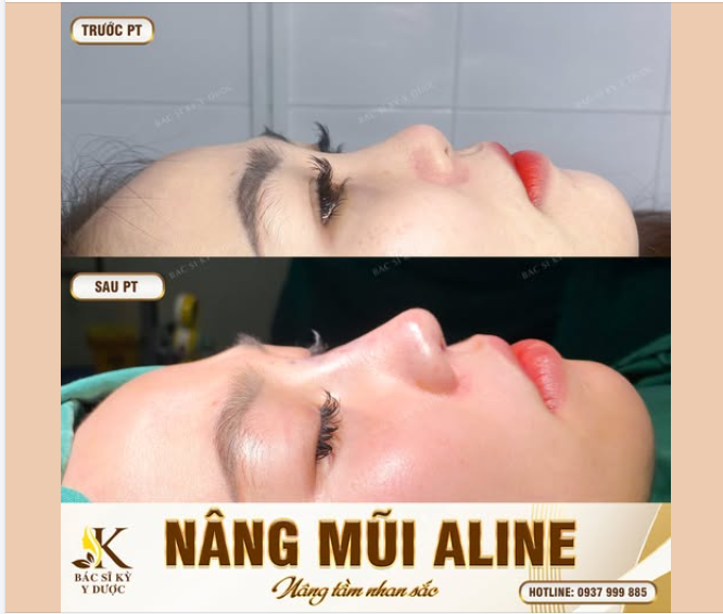 Kết quả sau Nâng mũi ALINE