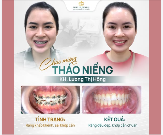 MỪNG NGÀY THÁO NIỀNG: KHÁCH HÀNG LƯƠNG THỊ HỒNG  "NIỀNG RĂNG LÀ QUYẾT ĐỊNH ĐÚNG ĐẮN NHẤT!"