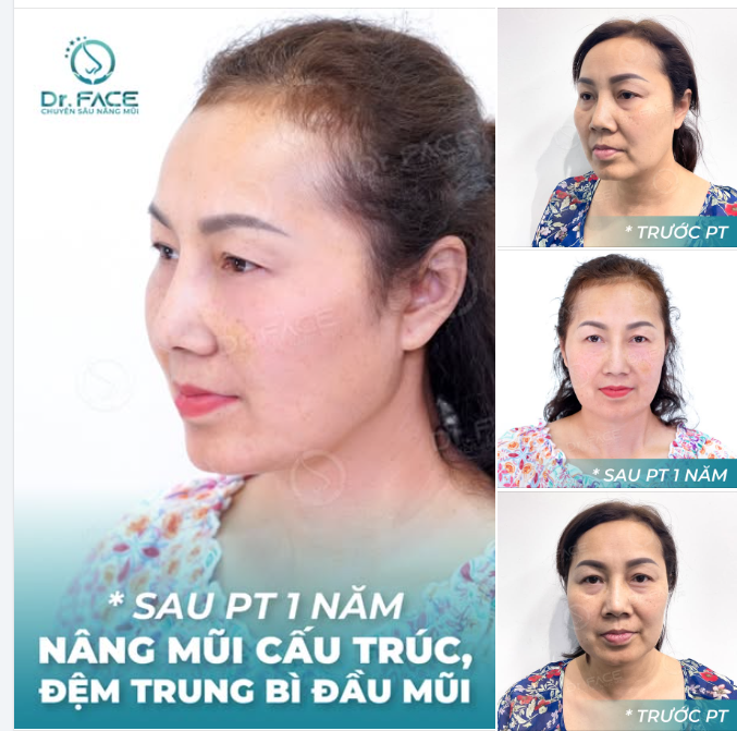 TÁI NGỘ SAU 1 NĂM – DÁNG MŨI ĐẸP, ĐẦU MŨI TRÒN MỀM