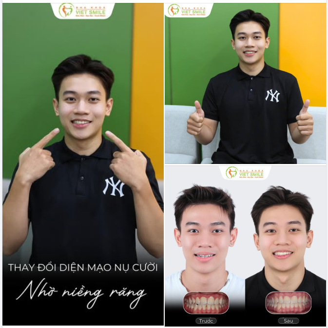 TRỌN VẸN CẢM XÚC NGÀY THÁO NIỀNG CỦA TUỆ KHANH TẠI VIET SMILE