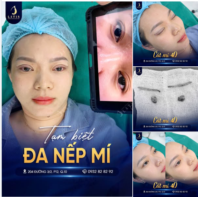 Tạm biệt mắt đa nếp mí  Chào đôi mắt trẻ trung với Cắt mí 4D