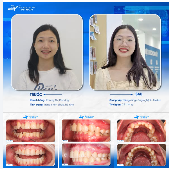 TẠM BIỆT HÀM RĂNG KHẤP KHỂNH - CÔ NÀNG SALE LOGISTICS BẬT VISUAL SAU KHI NIỀNG RĂNG