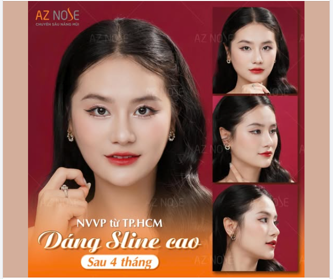 Gương mặt cân đối, thần thái tự tin của NVVP sau 4 tháng nâng mũi