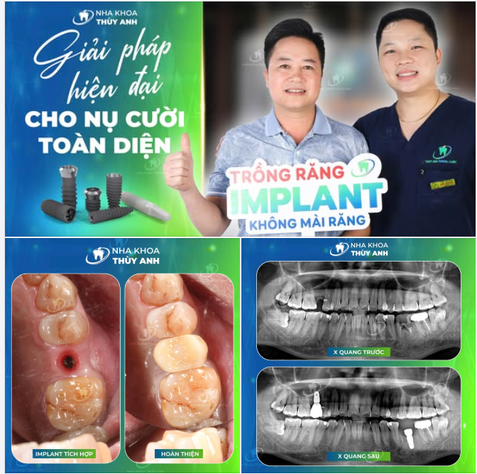 MẤT RĂNG KHÔNG CÒN LÀ NỖI LO KHI CÓ IMPLANT