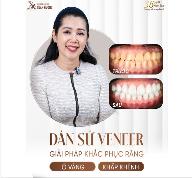 DÁN SỨ VENEER - GIẢI PHÁP XÓA BỎ RĂNG KHẤP KHỂNH, Ố VÀNG