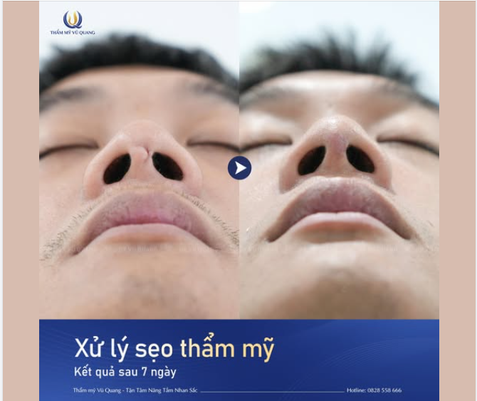 ĐÁNH BAY NỖI LO SẸO XẤU NÂNG MŨI CHỈ SAU 45 PHÚT