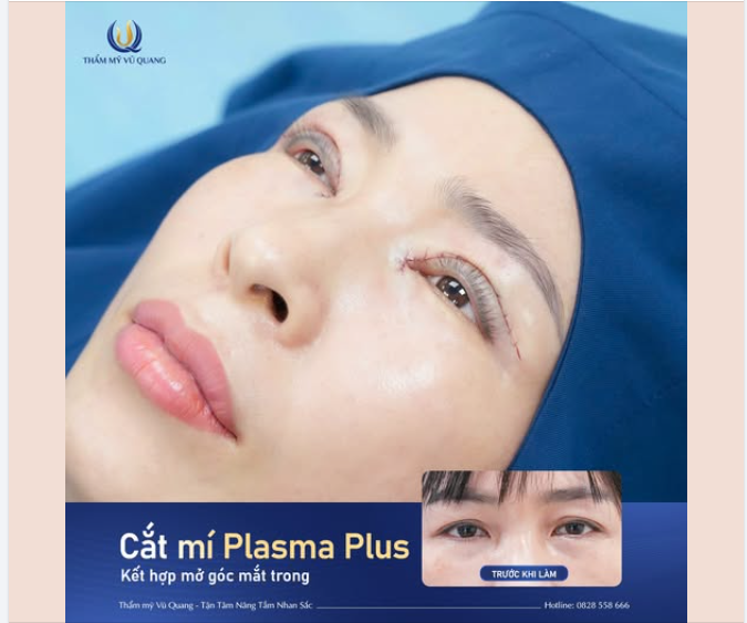 Cắt mí Plasma Plus kết hợp mở góc mắt trong