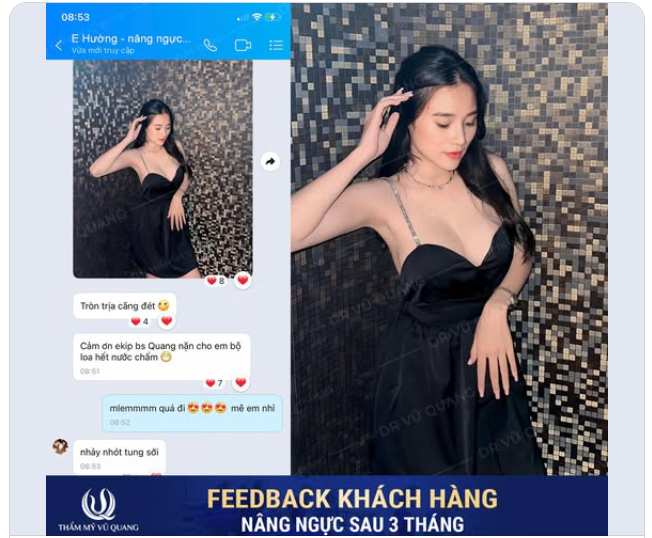 Feedback quá "ngọt" sau Nâng ngực Mentor MemoryGel Xtra sau 3 tháng