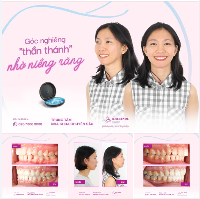 TÌM ĐƯỢC “GÓC NGHIÊNG THẦN THÁNH” NHỜ NIỀNG RĂNG TRONG SUỐT