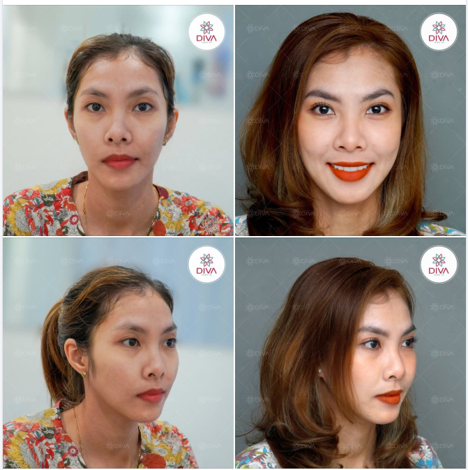 NHẤN MÍ MẮT - KHẮC PHỤC NẾP MÍ KHÔNG ĐỀU, CẢI THIỆN THẦN THÁI TOÀN KHUÔN MẶT!