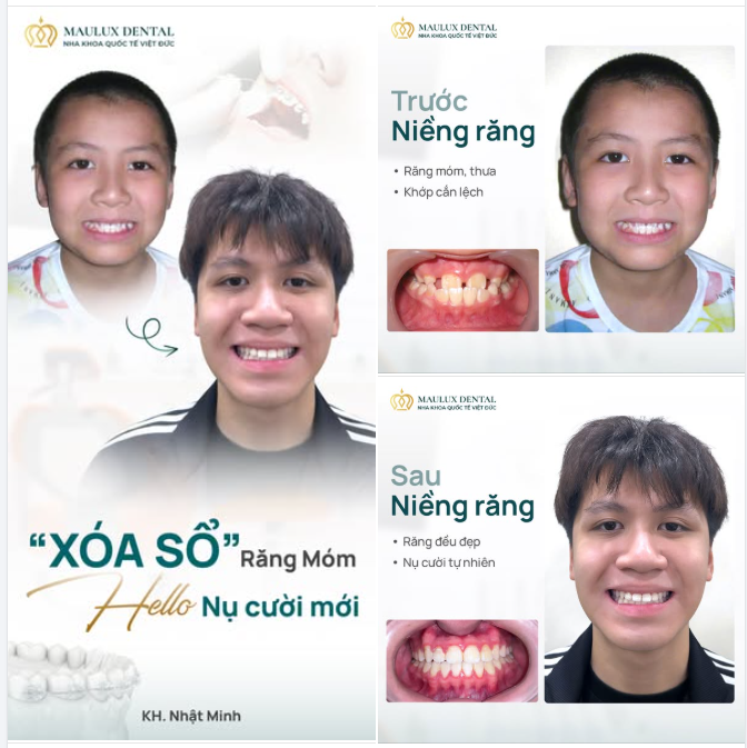 NIỀNG RĂNG – HÀNH TRÌNH LỚN LÊN CÙNG NỤ CƯỜI